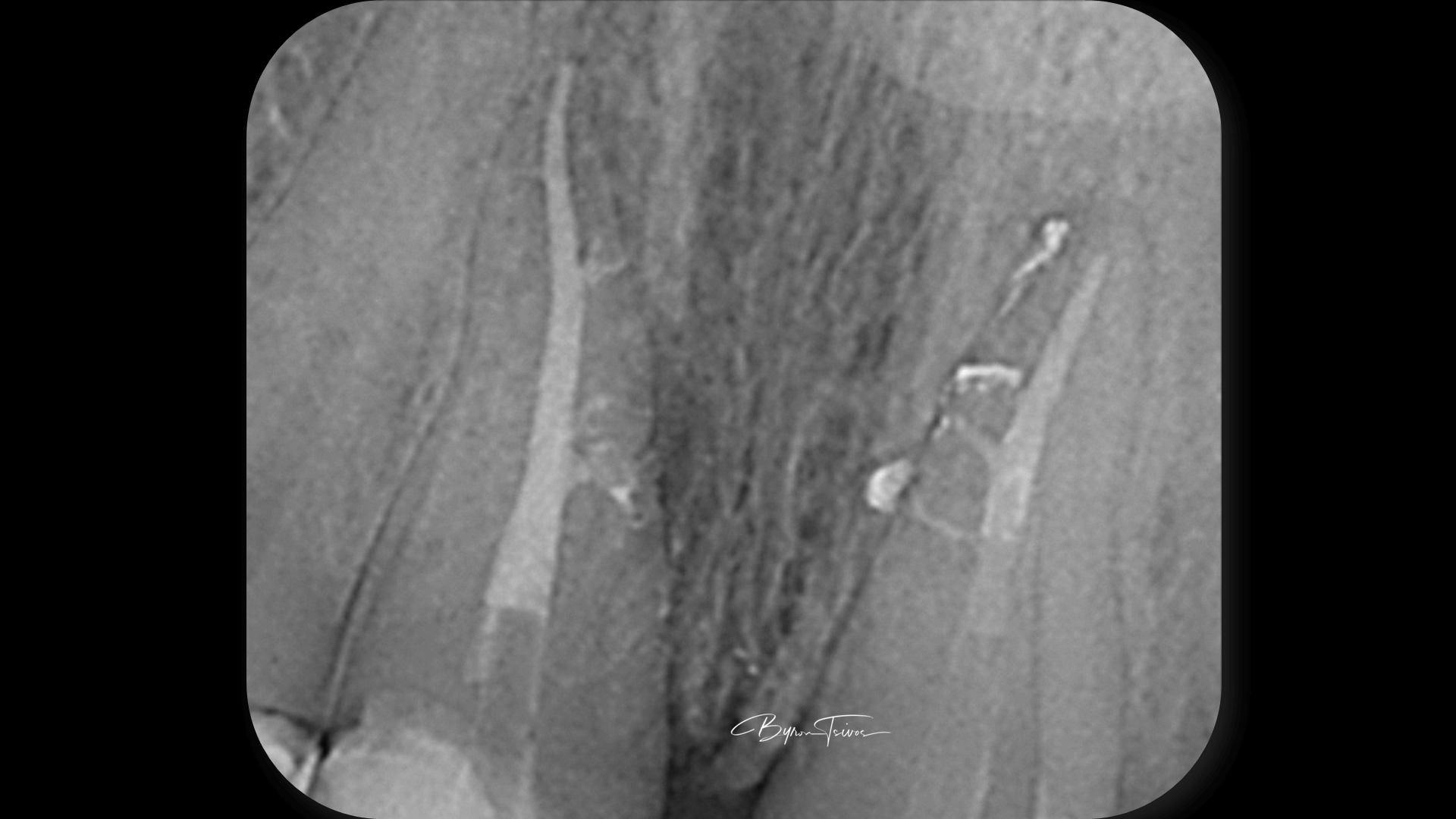 Broken Instrument Removal - Case 6